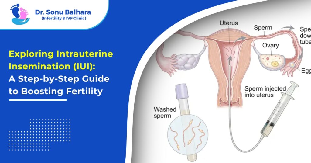 Exploring Intrauterine Insemination (IUI) A Step by Step Guide to Boosting Fertility